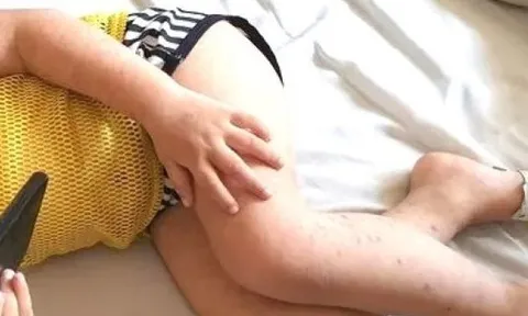 Bình Dương ghi nhận ca đầu tiên mắc tay chân miệng tử vong