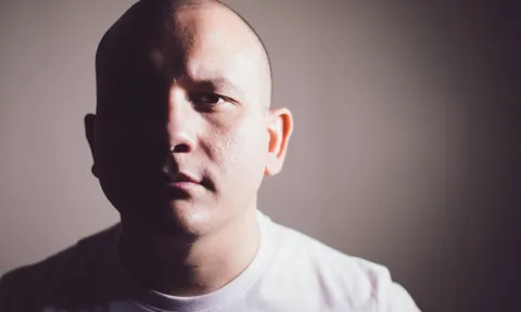 Đột phá: Trị dứt hói đầu nhờ... nốt ruồi