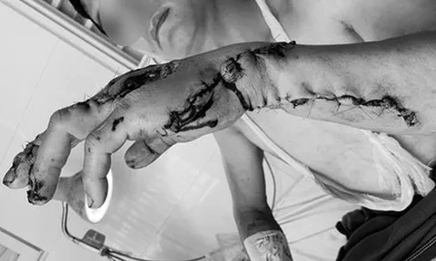 Người đàn ông ở Đồng Nai bị máy cưa đá ăn luôn cánh tay