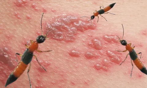 Loại côn trùng nọc độc hơn rắn hổ mang cắn khiến 2 người sưng vù mắt