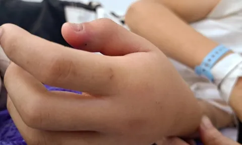 Bé trai bị rắn hổ mèo cắn trong sân nhà