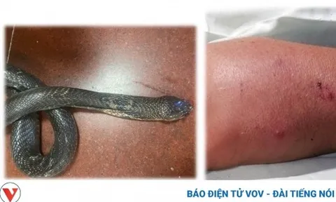 Truyền 70 lọ huyết thanh cấp cứu liên tiếp cho 3 bệnh nhân bị rắn cắn