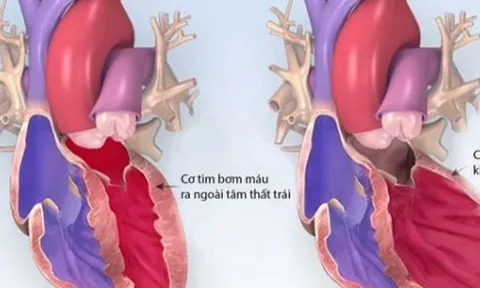 Bé 1 tuổi bị cao huyết áp