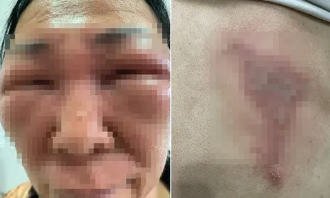 Bóp chết côn trùng rồi quẹt tay lên mặt, hai vợ chồng không mở nổi mắt