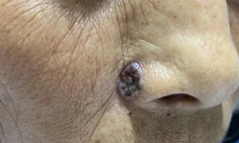 Tưởng là nốt ruồi bình thường, đi khám người phụ nữ tá hỏa khi biết mắc ung thư da hiếm gặp