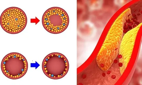 6 gạch đầu dòng cần nhớ để phòng ngừa mỡ máu cao ở tuổi 30