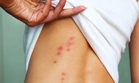 Nữ dược sĩ 28 tuổi tử vong sau khi mắc thuỷ đậu không rõ nguồn lây