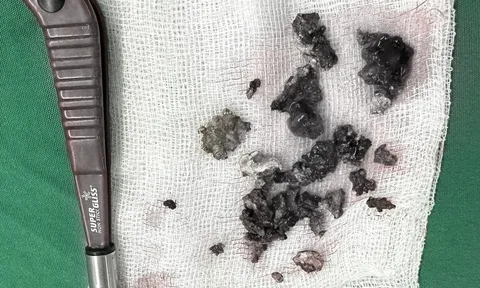 Lấy khối sỏi nằm trong hốc mũi bệnh nhân gần 30 năm