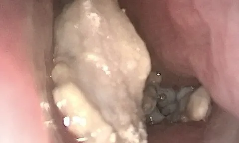 Hơn 30 năm bị dị vật hóa đá bít mũi mà không biết