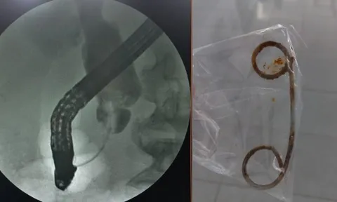 Nhiễm trùng nặng vì quên stent trong đường mật 2 năm