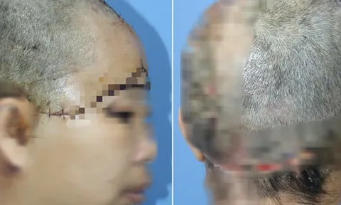 Người phụ nữ "bay" mất toàn bộ da đầu trong lúc phụ chồng khoan giếng