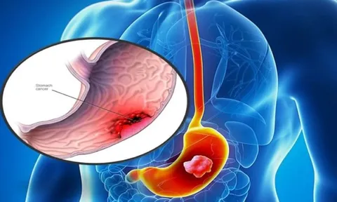 Chàng trai 25 tuổi bị ung thư dạ dày giai đoạn cuối vì thói quen khó bỏ
