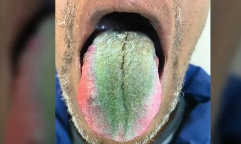 Kỳ lạ người đàn ông có lông mọc dày và xanh lè trên lưỡi