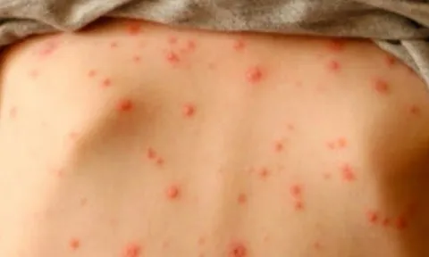 Bác sĩ Bệnh viện Bạch Mai cảnh báo nhiều trường hợp mắc thủy đậu tử vong