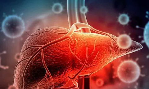 Phó Chủ tịch Hội Gan mật chỉ ra thủ phạm âm thầm “đục đẽo” lá gan tới xơ hỏng