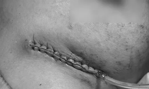 Biến dạng vì nâng ngực theo quảng cáo trên mạng xã hội