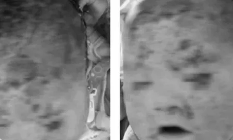 Bé trai bong tróc toàn bộ da mặt và đầu sau tắm lá