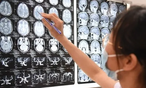 Triệu chứng tương đồng giữa u não và nhiễm sán lợn trên não