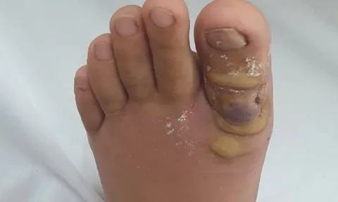 Tiện tay nhổ sợi lông chân, thiếu nữ phải nằm viện cả tuần