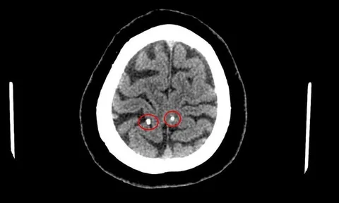 Sán làm tổ trong não vì thói quen ăn đồ sống