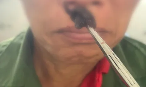 Đỉa làm tổ trong mũi người đàn ông ở Hà Giang