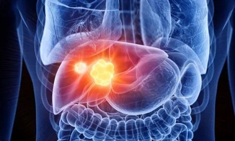 2 yếu tố khiến tỷ lệ tử vong do ung thư gan tăng vọt tại Anh: Nhiều người Việt cũng có 2 điểm này