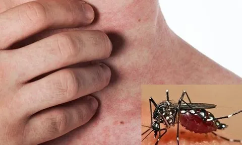 4 vấn đề sức khỏe bạn có thể gặp sau khi khỏi sốt xuất huyết