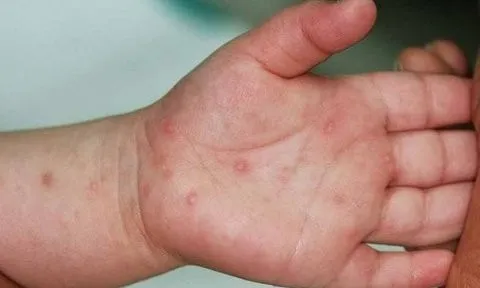Bình Thuận: Một ca tử vong do bệnh tay chân miệng