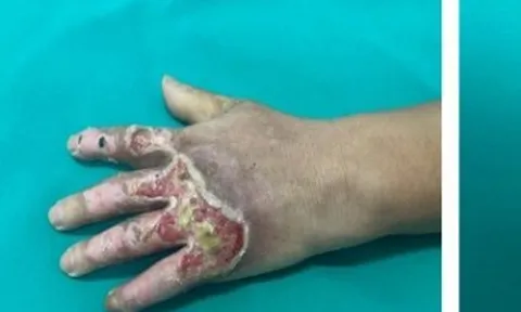 Đắp thuốc chữa bỏng không rõ nguồn gốc nên bị nhiễm trùng bàn tay