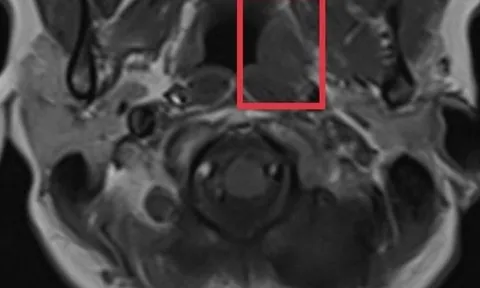 Cẩn trọng với loại ung thư nguy hiểm nhưng có triệu chứng mơ hồ