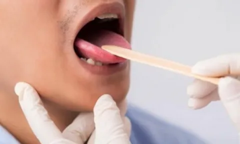 Đi khám vì có dấu hiệu lạ trong miệng, không ngờ nguyên nhân là ung thư