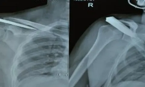 Mâu thuẫn gia đình, nam thanh niên bị đâm gãy dao