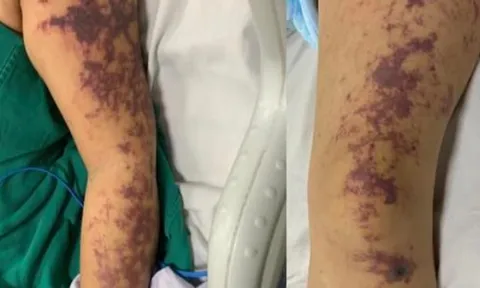 Người phụ nữ nguy kịch sau khi ăn món lòng lợn cùng gia đình