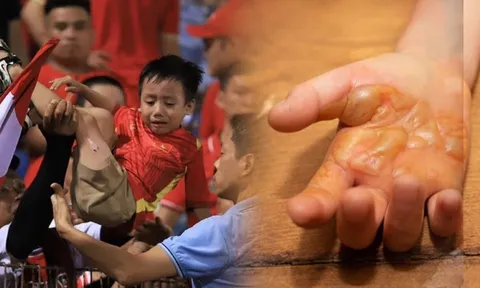 Từ vụ bé trai bị bỏng do pháo sáng trên sân Hàng Đẫy: Bác sĩ lưu ý khi xử trí vết bỏng