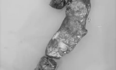 Viên sỏi “hình cây” trong đường mật người đàn ông