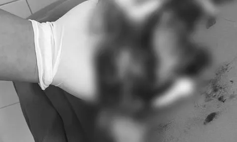 Điện thoại đang sạc phát nổ khiến người phụ nữ chấn thương nặng tay, mặt, cổ