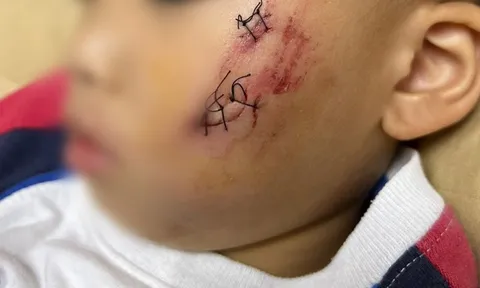 Đồng Nai: Bé trai 2 tuổi ở TP. Biên Hòa bị chó nghi dại cắn rách má