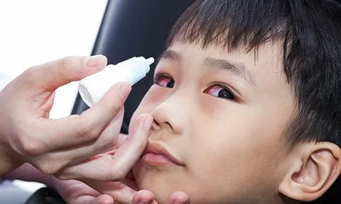 Dịch đau mắt đỏ vào mùa, bé có 5 dấu hiệu sau cha mẹ cần cho con đi khám ngay