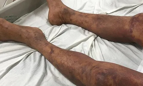 Người đàn ông tím đen cơ thể sau khi ăn thịt lợn ốm