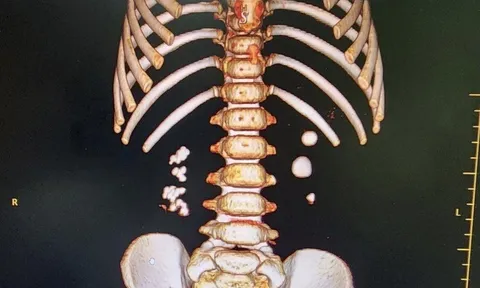 Bé trai 3 tuổi đi khám vì đau thắt lưng, đau mạn sườn, bác sĩ phát hiện bị sỏi thận 2 bên