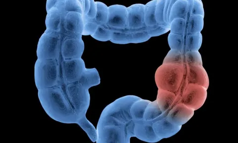 Thói quen xấu khiến nguy cơ mắc ung thư đại tràng tăng vọt: Nhiều người có mà không biết