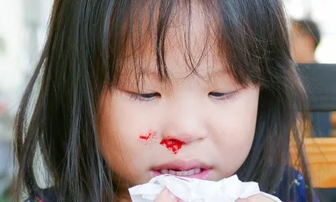 Bé trai 3 tuổi nguy kịch do bà nội xử lý chảy máu cam sai cách