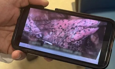 Chàng trai 20 tuổi có phổi chi chít đốm đen: “Phổi của tôi bị tổn thương vĩnh viễn chỉ vì một thói quen sai lầm”