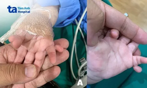 Bé gái sinh ra khác thường với 24 ngón tay, chân