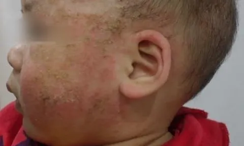 Trị viêm da cơ địa bằng tắm lá, bé 8 tháng tuổi biến chứng nặng