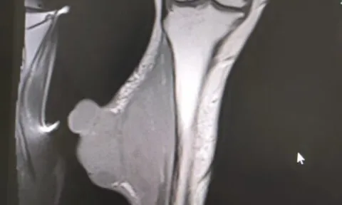 Thấy “vảy ốc” ở chân, người phụ nữ đi khám phát hiện ung thư di căn