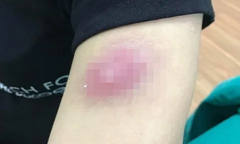 Hà Nội: Chi hàng chục triệu tiêm tan mỡ cô gái trẻ nổi u cục chi chít