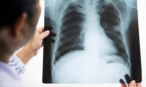 6 nhóm người dễ mắc ung thư phổi hơn bất cứ ai