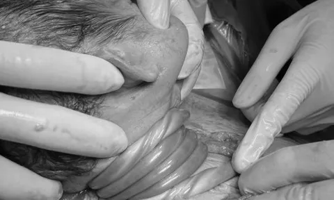 Cấp cứu kịp thời trường hợp suy thai cấp do dây rốn quấn cổ 5 vòng