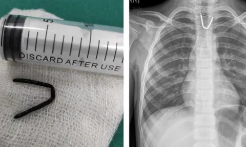 Hoảng hồn khi thấy đoạn kim khí sắc nhọn mắc trong họng bé 8 tuổi